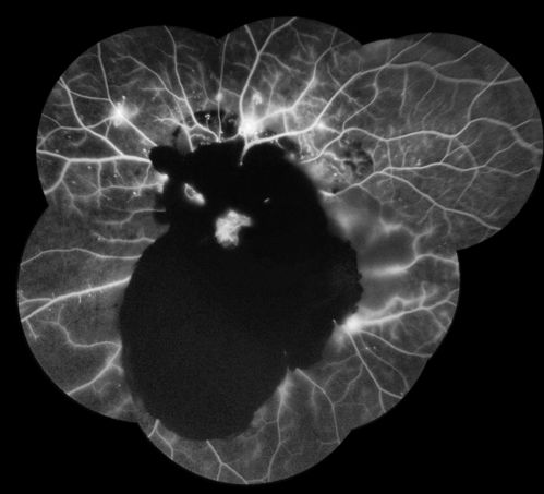 Severe Hemorrhage from NVD and NVE Due To PDR
60 year old female with Diabetic Retinopathy.  VA 20/40 OD HM OS.  History of Dot and Blot hemorrhages and cotton-wool spots associated with Diabetes.  Severe Hemorrhaging due to NVD and NVE.  Pt stated sight decreased very rapidly.
Keywords: diabetic, retinopathy, hemorrhage, blood, cotton-wool, PDR, IDDM