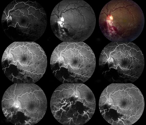 Cytomeglovirus
25 year old male experiencing blurry vision OS for two days.  Onset very rapid.  VA 20/40 OS 20/30 OD.  After HIV titer test, determined the pt. had HIV and Cytomeglovirus.
Keywords: cytomeglovirus, brvo, hiv
