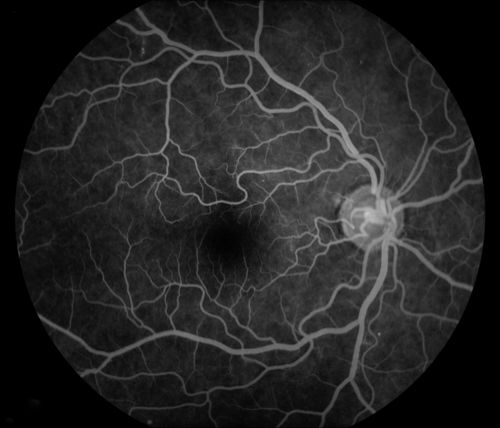 Cytomeglovirus
25 year old male experiencing blurry vision OS for two days.  Onset very rapid.  VA 20/40 OS 20/30 OD.  After HIV titer test, determined the pt. had HIV and Cytomeglovirus.
Keywords: cytomeglovirus, brvo, hiv