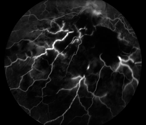 Cytomeglovirus
25 year old male experiencing blurry vision OS for two days.  Onset very rapid.  VA 20/40 OS 20/30 OD.  After HIV titer test, determined the pt. had HIV and Cytomeglovirus.
Keywords: cytomeglovirus, brvo, hiv