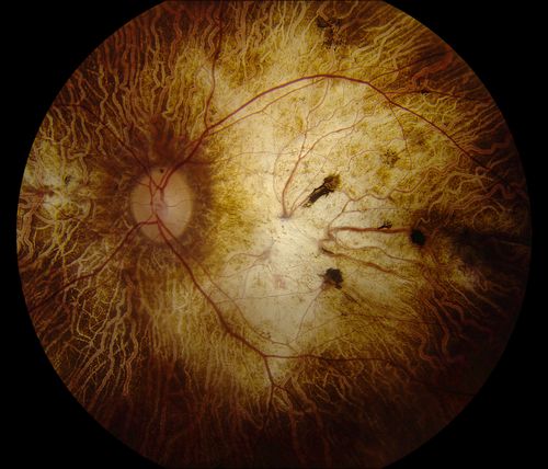 Chorodial Sclerosis
74 year old female diagnosed with Chorodial Sclerosis OU and ARMD OU.  Va 20/400 OD 2'200 OS
Keywords: wet amd, choroid, chorodial, sclerosis