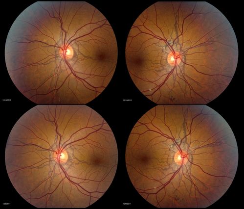 PXE with Angioid Streaks (4-up for comparison)
PXE with angioid streaks OU, 4-up for comparison between 2010 and 2011 - angioid streaks are stable.
Mots-clés: Angioid;Streaks