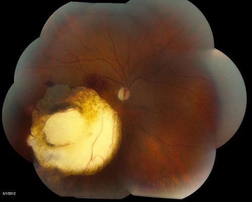 Choroidal Malignant Melanoma - Montage
Choroidal malignant melanoma status post plaque radiotherapy OD in 1986, patient also has a submacular hemorrhage OD, and radiation retinopathy OD.
Schlüsselwörter: Choroidal;Malignant;Melanoma;submacular;hemorrhage;retinopathy