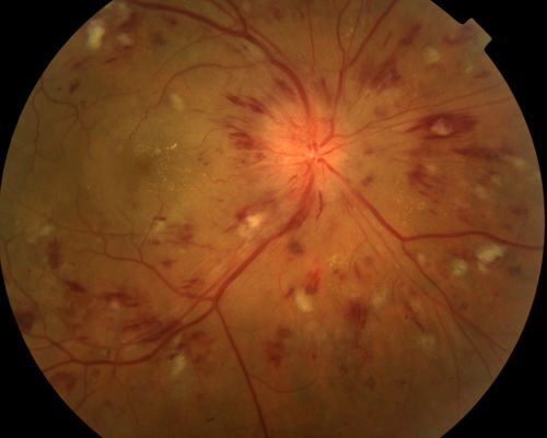 hypertension retinopathy w/ disc edema and CRVO
64 year old white male w/ a vision of 20/200 which eventually improved to 20/60 without treatment
