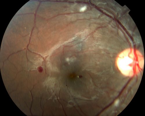HTN Retinopathy w/ cotton wool spots and hemorrhages
23 year old african american male w/ visual acuity of 20/20
