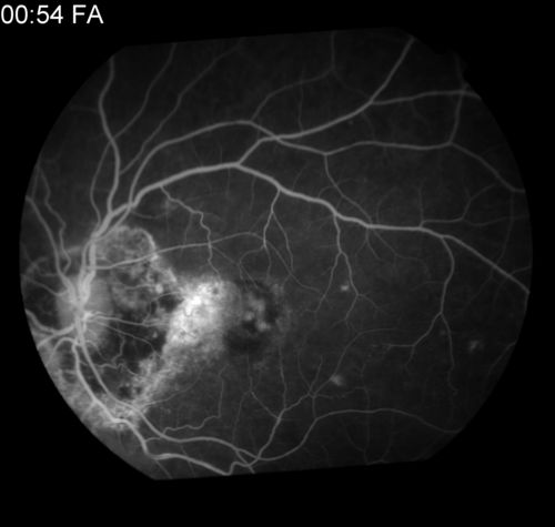 CNVM
Possible Chorioretinitis
Keywords: FA, Angiogram