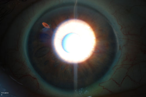 Peripheral Iridotomy
Slit lamp photo of peripheral iridotomy for narrow angles. A hole was place at 10-o'clock superior temporally. 
