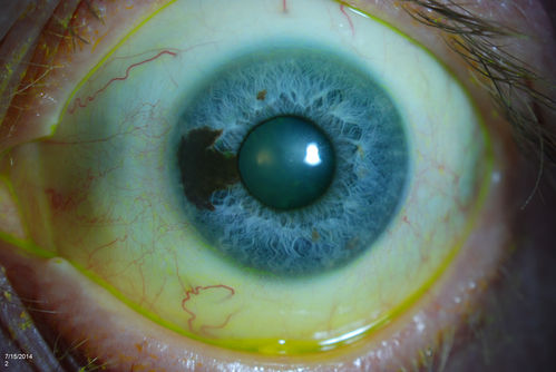 Iris Nevus
Patient came in for cataract evaluation. VA 20/200, right eye, 20/60, left eye. Slit lamp photography shows iris nevus 3-4 mm located nasally at 9-o'clock in the left eye. 
