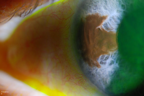 Iris Nevus
Patient came in for cataract evaluation. VA 20/200, right eye, 20/60, left eye. Slit lamp photography shows iris nevus 3-4 mm located nasally at 9-o'clock in the left eye. 
