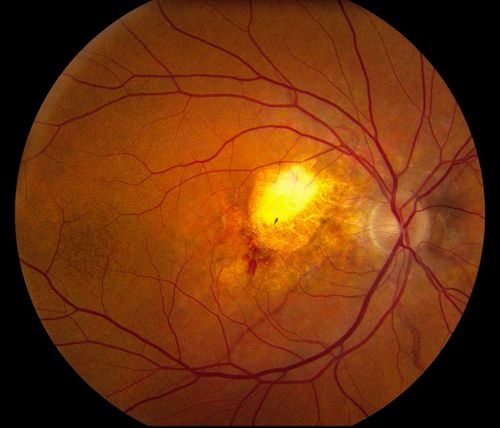 Pseudoxanthoma Elasticum with CNV
Keywords: macular degeneration