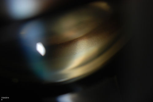 Silicone Oil Bubbles in the Angle
Patient is evaluated for glaucoma associated with ocular inflammation. VA is CF in the right eye and 20/50, left eye. Gonioscopy photos shows little silicone oil bubbles in the inferior angle of the right eye. Patient to consider removal of silicone oil. 
