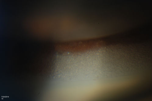 Silicone Oil Bubbles in the Angle
Patient is evaluated for glaucoma associated with ocular inflammation. VA is CF in the right eye and 20/50, left eye. Gonioscopy photos shows little silicone oil bubbles in the inferior angle of the right eye. Patient to consider removal of silicone oil. 
