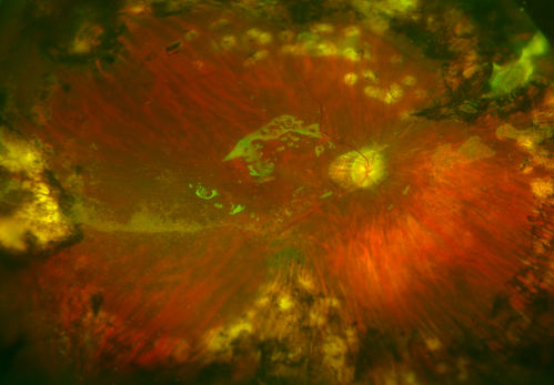 Old Retinal Detachment Repair with Silicone Oil
Patient comes in for eval on glaucoma. Patients VA in the right eye was CF in the right eye and 20/50. left eye. Fundus photography shows old retinal detachment with scattered laser scars in the periphery. Silicone oil visible in the macula as well. 
Keywords: july2014