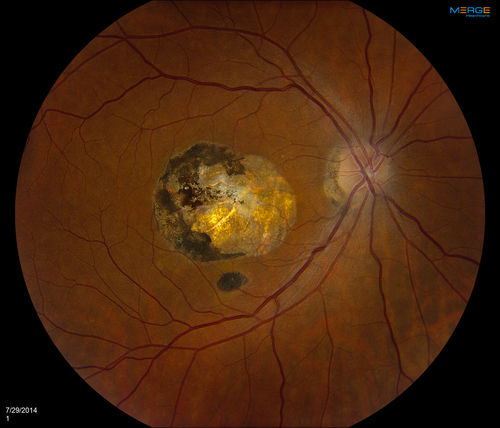 Macular Scar
Fundus photography with Auto Fluorescent shows macular scar centrally, right eye. VA is 20/200 in the right eye. 
Keywords: august2014