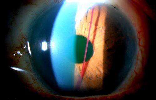 Blood Strand through Anterior Chamber
