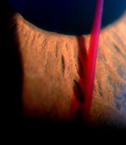 Blood strand into the anterior chamber
