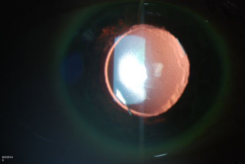 Trans-Illumination Defect with Fuch's Dystrophy.
Patient comes in for eval on post cataract surgery. VA is 20/30 both eyes. Slit lamp exam shows Fuch's Dystrophy on the cornea on the right eye. IOL haptics are chaffing the iris therefore producing trans illumination defect in the right eye. 
