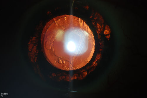 Trans-Illumination Defect with Fuch's Dystrophy.
Patient comes in for eval on post cataract surgery. VA is 20/30 both eyes. Slit lamp exam shows Fuch's Dystrophy on the cornea on the right eye. IOL haptics are chaffing the iris therefore producing trans illumination defect in the right eye. 
