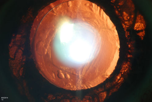 Trans-Illumination Defect with Fuch's Dystrophy.
Patient comes in for eval on post cataract surgery. VA is 20/30 both eyes. Slit lamp exam shows Fuch's Dystrophy on the cornea on the right eye. IOL haptics are chaffing the iris therefore producing trans illumination defect in the right eye. 
