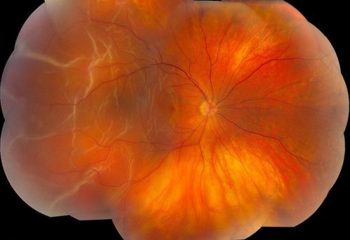 Retinal Detachment
Schlüsselwörter: Retinal Detachment