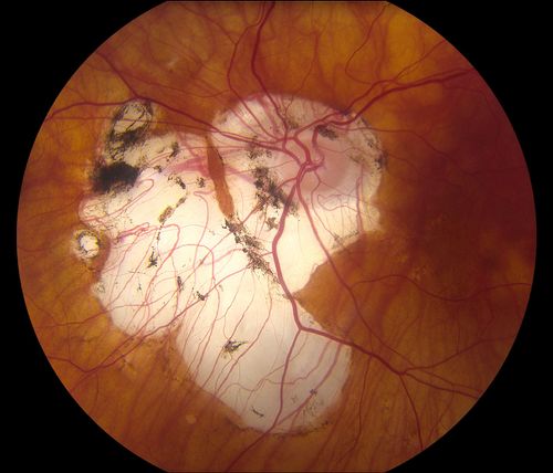 Myopic Degeneration with RPE Loss
Patient comes in for follow up for glaucoma. VA is 20/30 in both eyes. Fundus photography shows the RPE loss due to myopic degeneration, nasally, inferiority in the left eye.
Keywords: october2013