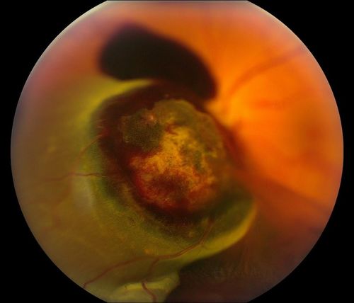 Choroidal Melanoma
