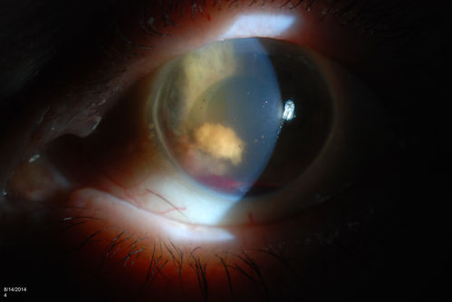 Ghost Cell Glaucoma
Post cataract surgery, patient presents with ghost cell in the anterior chamber after hemorrhage cleared. A small hyphema still is visible in the anterior chamber with a whitish ball appearance. 
