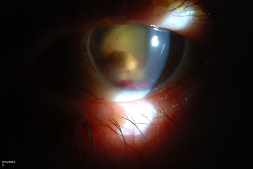 Ghost Cell Glaucoma
Post cataract surgery, patient presents with ghost cell in the anterior chamber after hemorrhage cleared. A small hyphema still is visible in the anterior chamber with a whitish ball appearance. 
