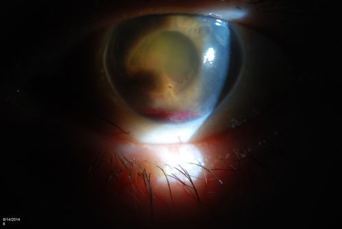 Ghost Cell Glaucoma
Post cataract surgery, patient presents with ghost cell in the anterior chamber after hemorrhage cleared. A small hyphema still is visible in the anterior chamber with a whitish ball appearance. 
