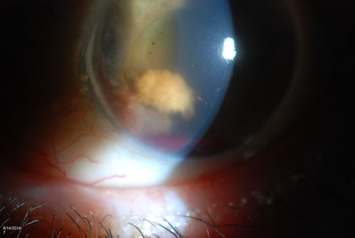Ghost Cell Glaucoma
Post cataract surgery, patient presents with ghost cell in the anterior chamber after hemorrhage cleared. A small hyphema still is visible in the anterior chamber with a whitish ball appearance. 

