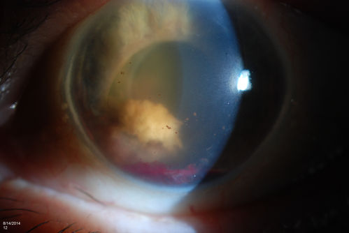 Ghost Cell Glaucoma
Post cataract surgery, patient presents with ghost cell in the anterior chamber after hemorrhage cleared. A small hyphema still is visible in the anterior chamber with a whitish ball appearance. 
