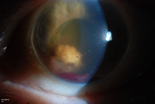 Ghost Cell Glaucoma
Post cataract surgery, patient presents with ghost cell in the anterior chamber after hemorrhage cleared. A small hyphema still is visible in the anterior chamber with a whitish ball appearance. 
