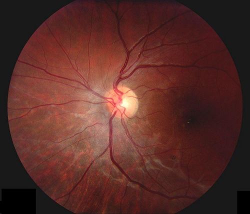 Mots-clés: macular pucker