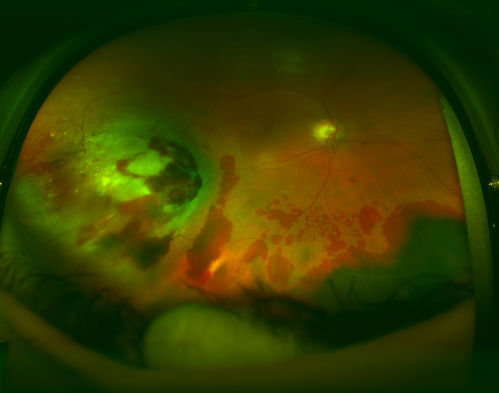 Treated Choroidal Melanoma
Follow up patient for melanoma in the right eye that was treated with proton beam therapy. VA is 20/50 in the right eye. Fundus photo shows scattered hemorrhages inferiorly with tumor temporal inferior at 8-o'clock. Patient will be followed up in 6-months
Keywords: july2014