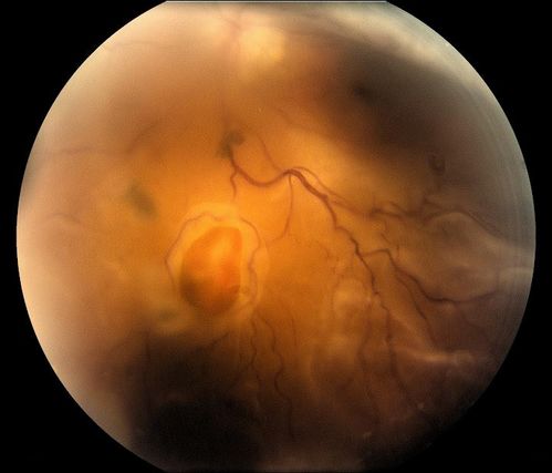 Retinal Tear
Keywords: Retinal Detachment