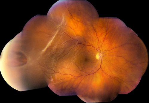 Retinal Detachment
Keywords: Retinal Detachment