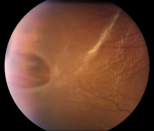 Schlüsselwörter: Retinal Detachment