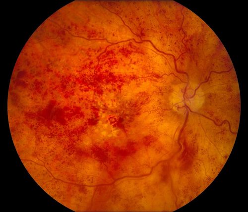 Hemorrhage with Cystoid Macular Edema 
Keywords: cme