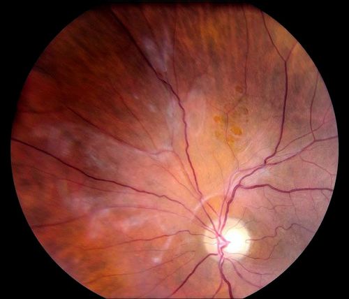 Schlüsselwörter: macular pucker