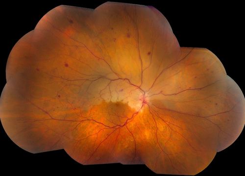 Montage of Hemi-Central Retinal Artery Occlusion
Võtmesõnad: CRAO