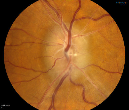 Bilateral Papilledema 
Young male presents with decreased vision in both eyes. Fundus photos reveal swollen optic nerves in both eyes.
