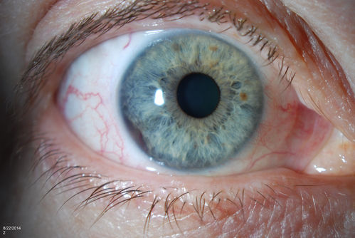 Gonioscopy, Mass in the Angle of Anterior Chamber
Slit Lamp and goinoscopy photos show a mass at 7-o'clock i the right eye. The mass extends beneath the iris behind the lens. 

