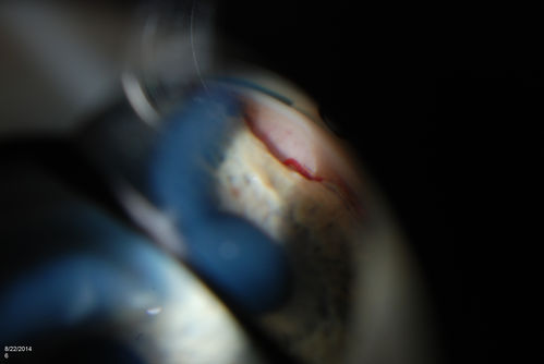 Gonioscopy, Mass in the Angle of Anterior Chamber
Slit Lamp and goinoscopy photos show a mass at 7-o'clock i the right eye. The mass extends beneath the iris behind the lens. 
