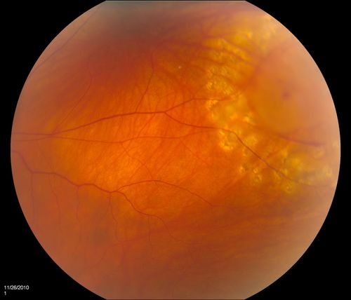 Retinal Tear treated with Laser 
Keywords: Retinal Detachment