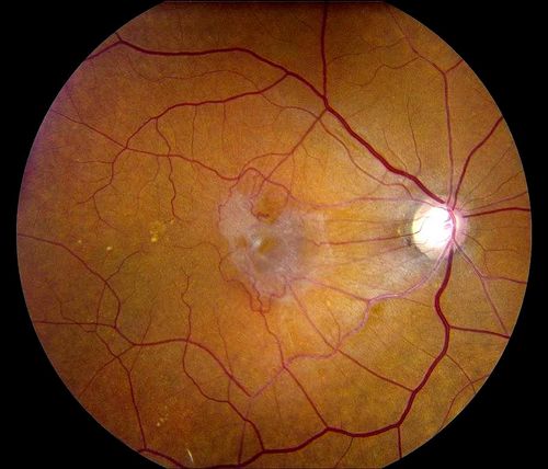 Palabras clave: macular pucker