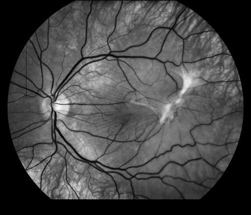 Keywords: macular pucker