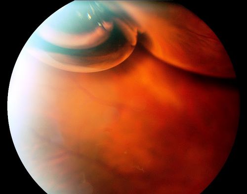 C3F8 Gas Bubble for retinal tear/ Pneumatic Retinopexy
Keywords: Retinal Detachment
