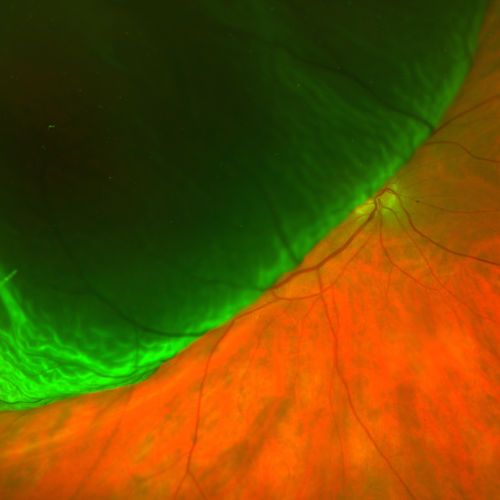 Bullous Retinal Detachment
Patient comes in with a curtain down in his vision in the right eye. Patient was hand motion. Fundus photograph shows retinal detachment with macula detached temporal superiorly in the right eye. There were 3-retinal tears between 10-12-o'clock. Schedule scleral buckle to fix RD.

