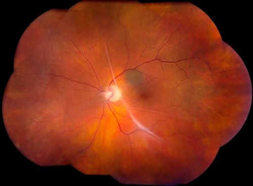 Keywords: macular pucker