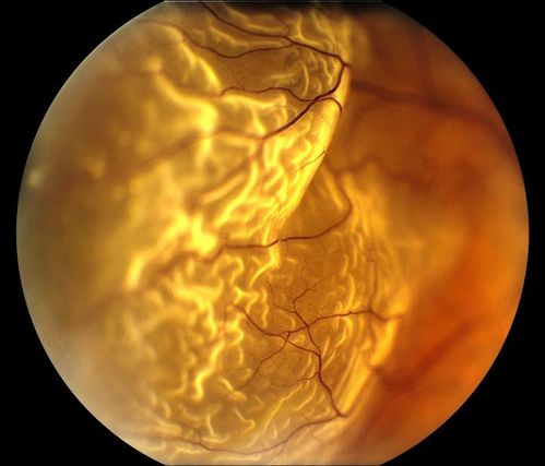 Retinal Detachment
Keywords: Retinal Detachment